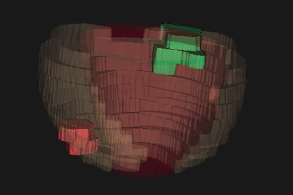 Detaillierter Befundbericht mit exakter Kartierung der Prostata-Läsionen