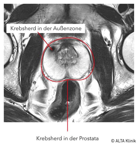 Prostatakrebs im Prostata-MRT