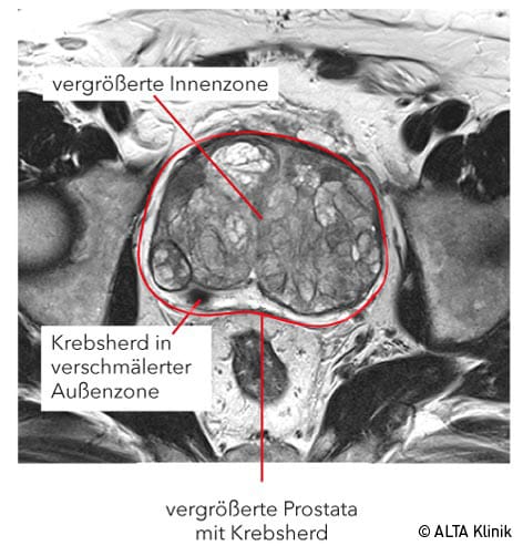 Prostatavergrößerung im Prostata-MRT