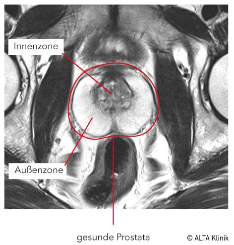 prostata anatomie mrt