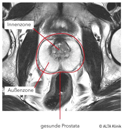 Gesunde Prostata im Prostata-MRT