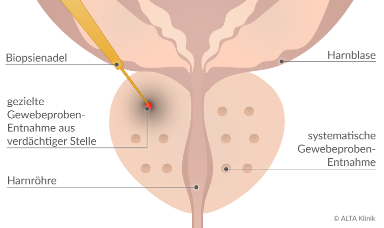 prostata biopsie wahrscheinlichkeit