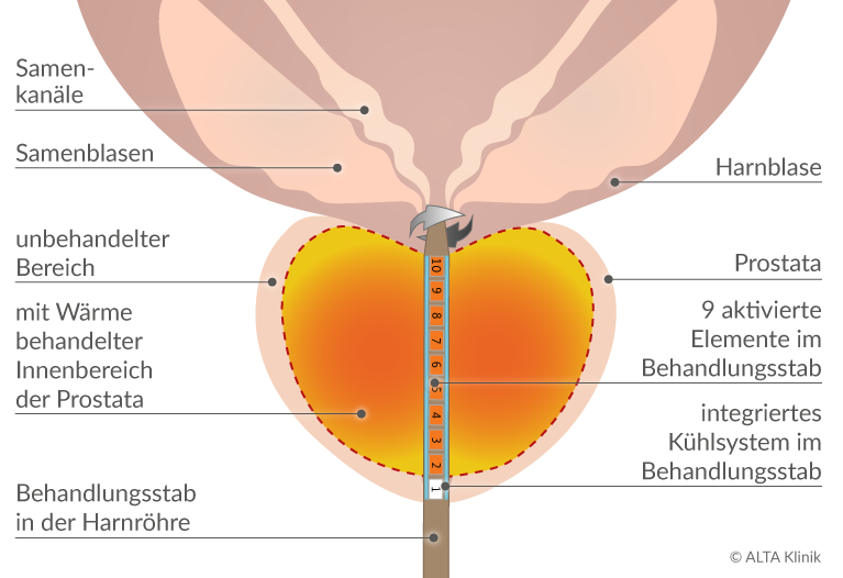 prostata normale größe cm)