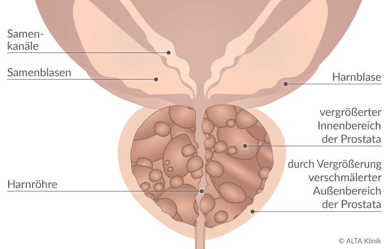 prostata knoten gutartig