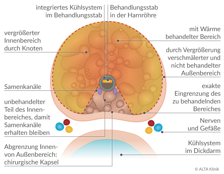 Prostata knoten gutartig, Click 