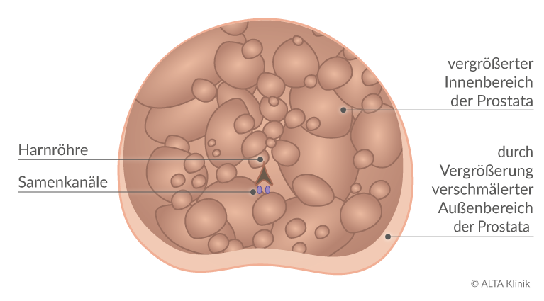 prostata knoten gutartig)