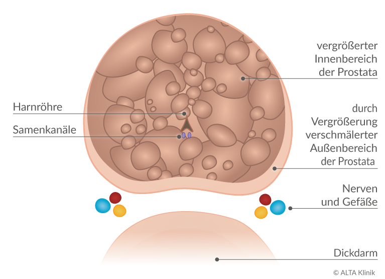 Behandlung zur Prostataverkleinerung