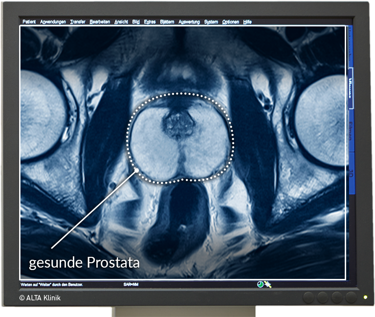 Prostatitis a férfiak kezelési következményeiben prosztata műtét után tünetei