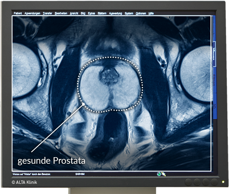 prostatitis a férfiak kezelésében Thermack)