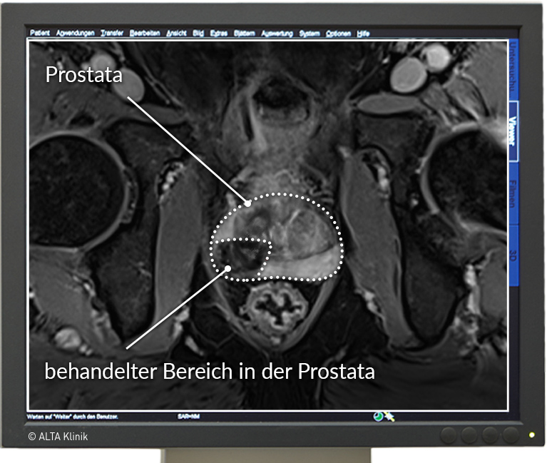 Prostata erhaltende Therapie mit MRT - HIFU