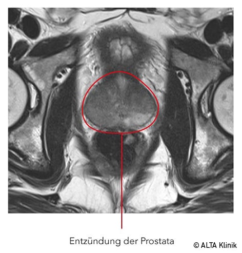 prostata mrt auswertung Mi a hasznos propolis a prosztatitisben