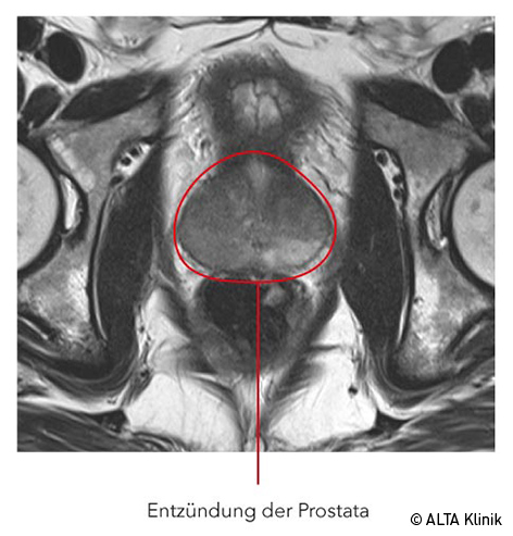 prostata mrt auswertung)