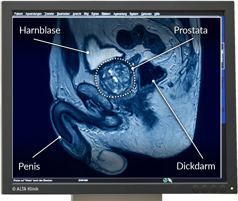 prostata anatomie mrt