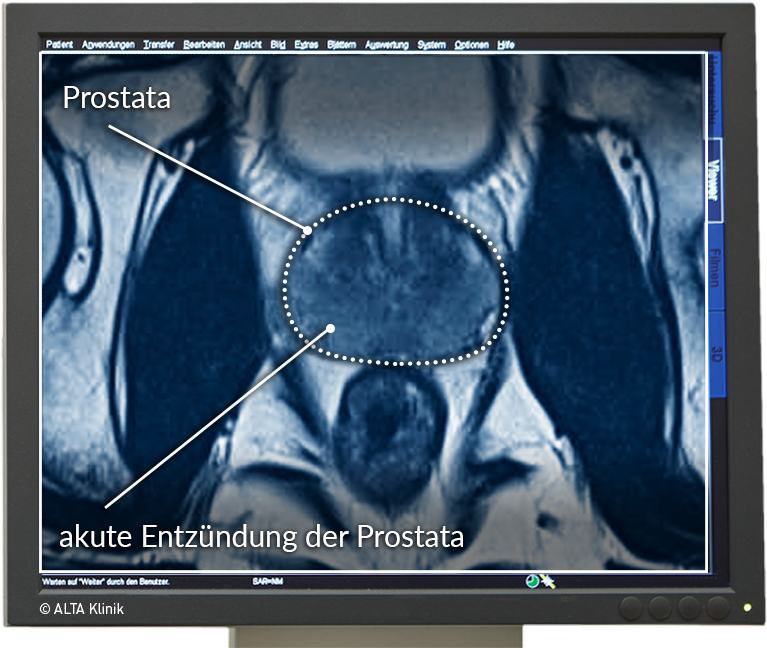 akut prostatitis)