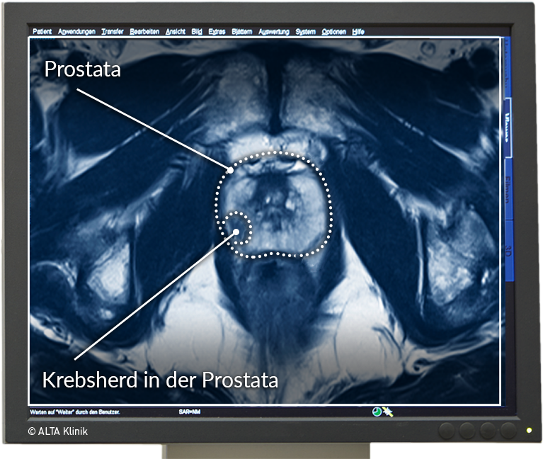 prostata mrt auswertung A prostatitis exacerbations eltávolítása