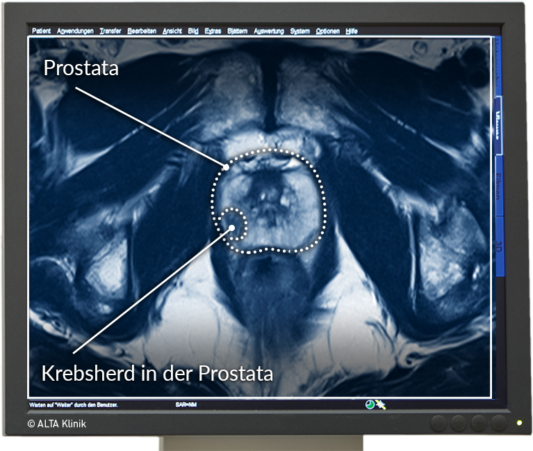 prostata mrt auswertung)