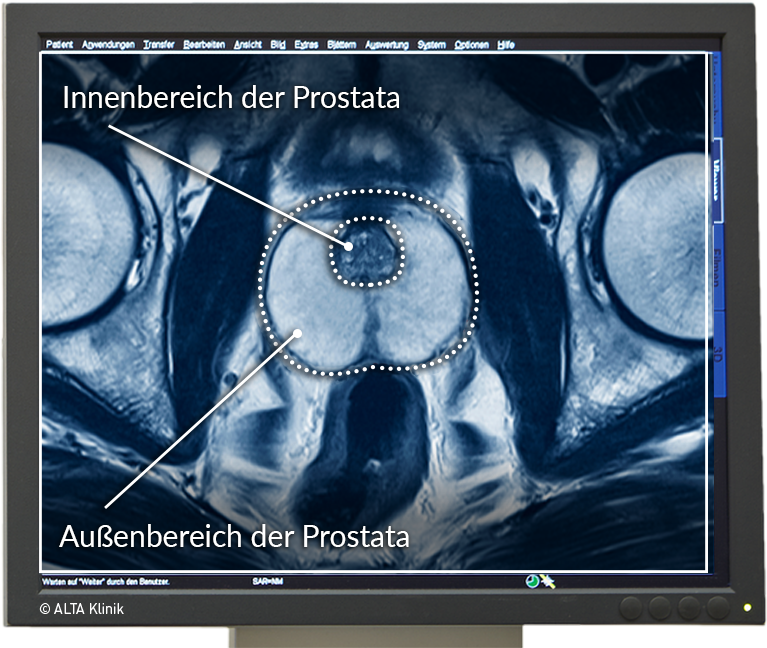 prostata knoten gutartig)