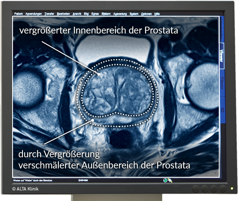 prostata knoten gutartig)