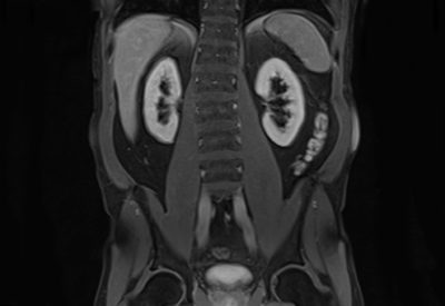 MRT Abdomen und Becken