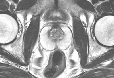 MRT Prostata