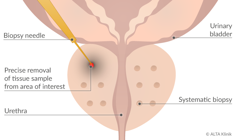 biopsie pentru prostatită