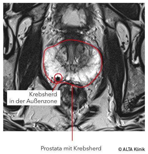 Prostatakrebs im MRT