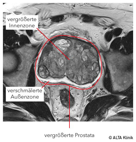 psa wert prostata 10