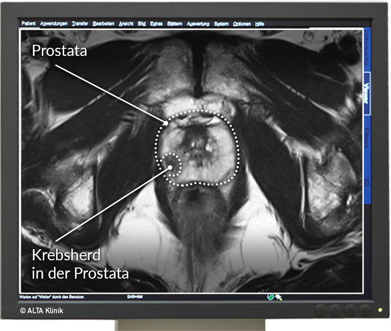 prostata mrt ohne kontrastmittel