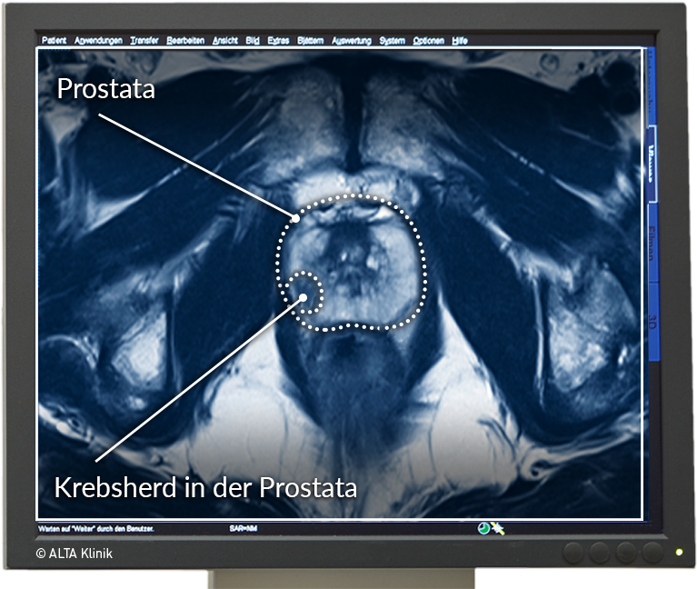 prostata biopsie wahrscheinlichkeit