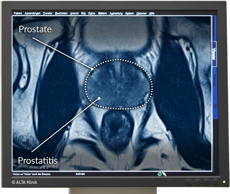 How prostatitis vilichit