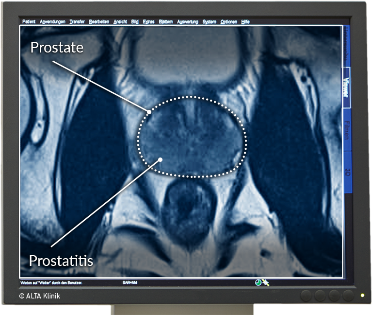 chronische abakterielle prostatitis behandlung