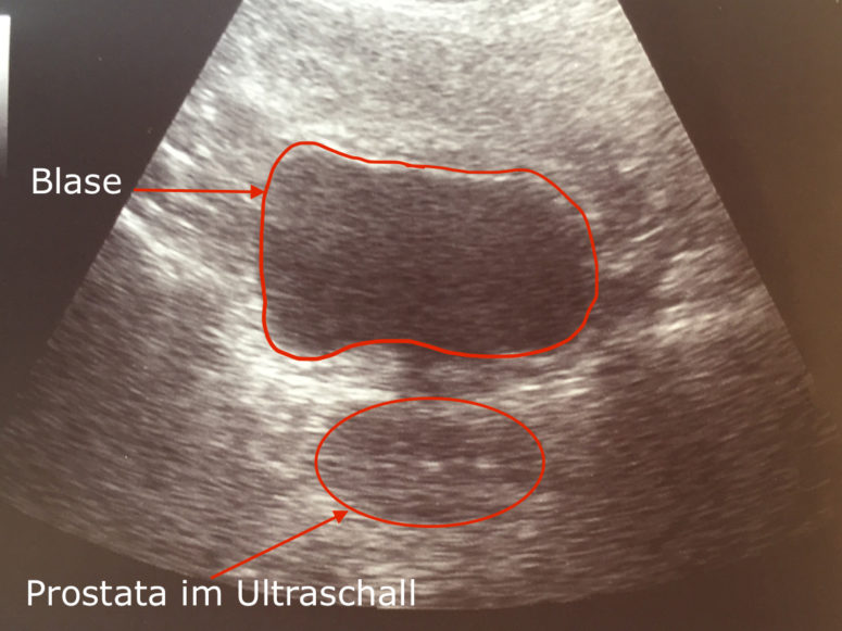 prostata normale größe sonographie