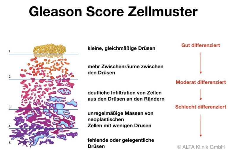 Gleason Score Zellmuster