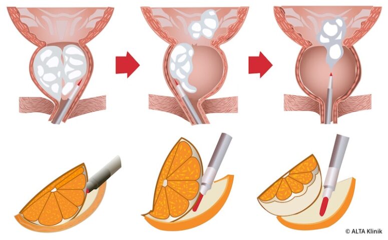 HoLEP Illustration