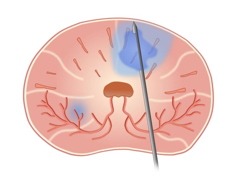 Biopsie Probenentnahme ALTA Klinik