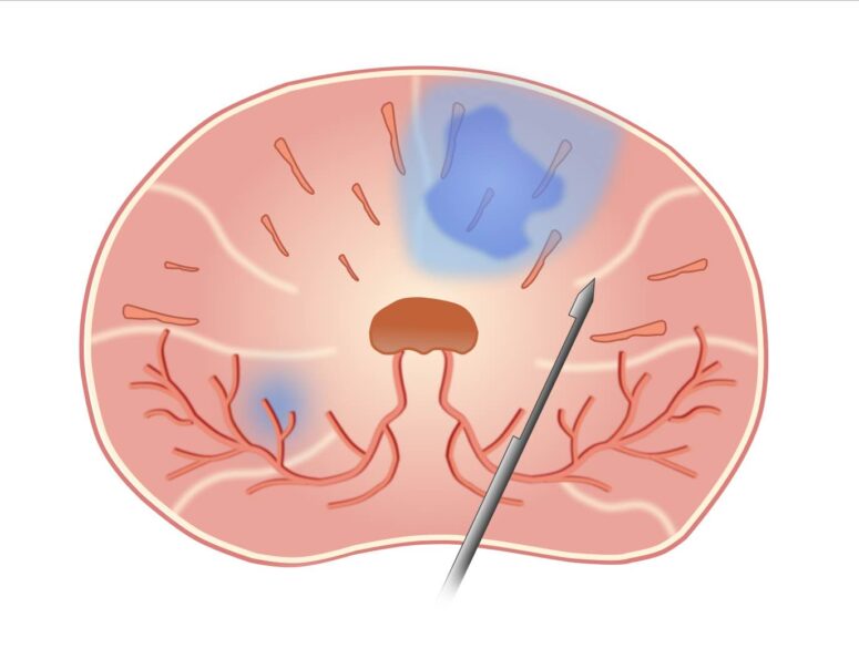 Probenentnahme Biopsie Problem