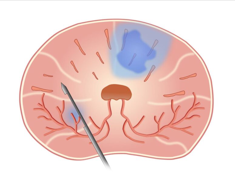 Biopsie Probenentnahme Problem