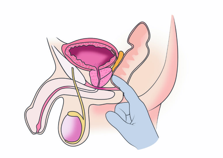 prostatahyperplasie operation prosztata 3 szakasz
