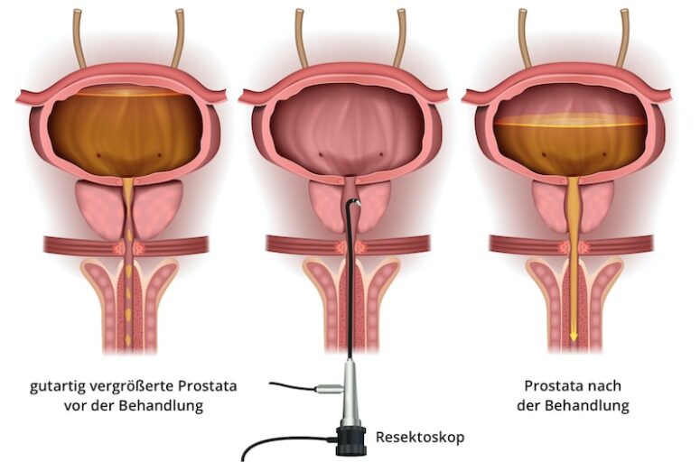 TURP Darstellung