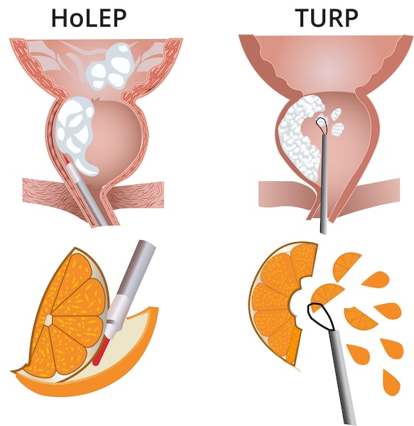 TURP und HoLEP im Vergleich