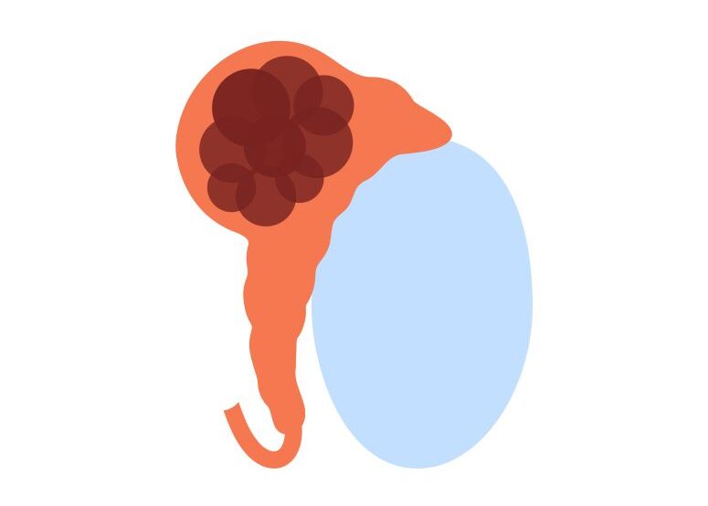Hodenkrebs Illustration