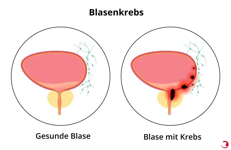 Blasenkrebs Illustration