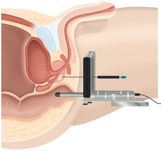Stanzbiopsie