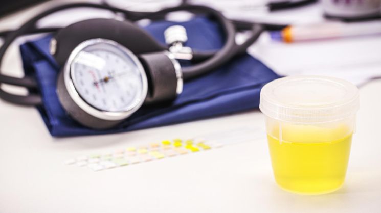 Diagnostik bei Verdacht auf eine Glomerulonephritis