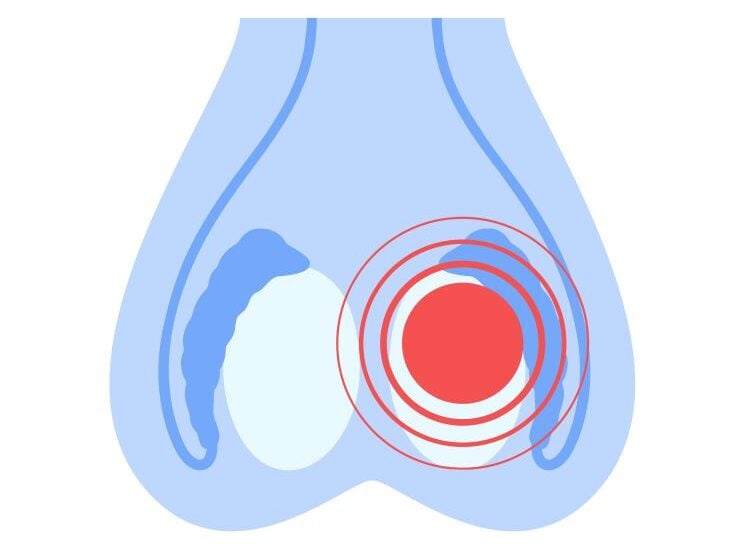 Darstellung einer Nebenhodenentzündung - Illustration