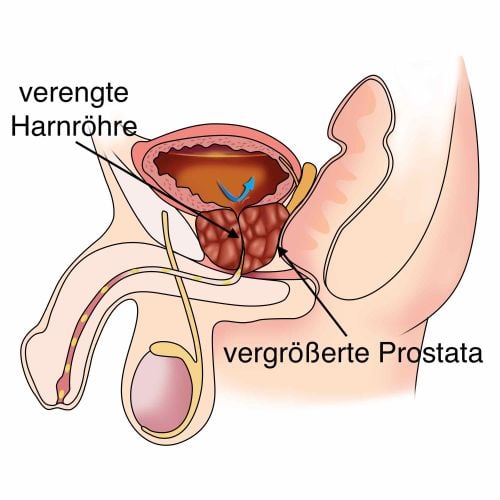 Prostatavergrößerung - vergrößerte Prostata