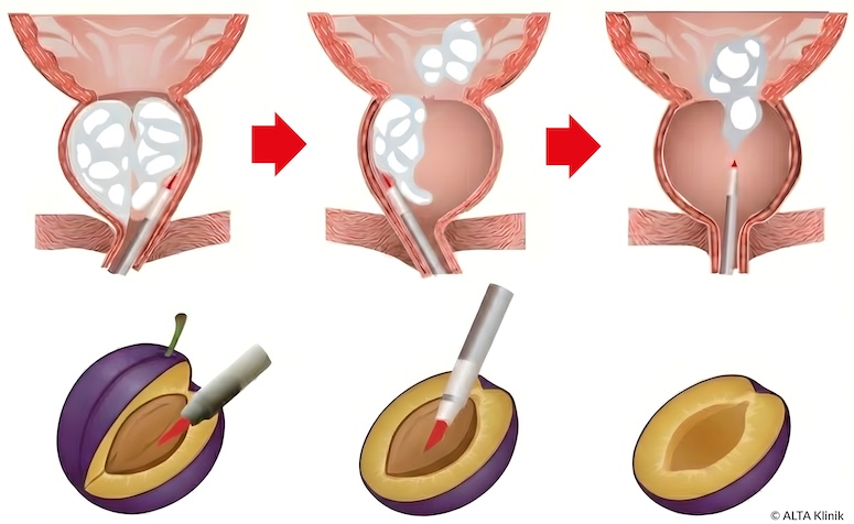HoLEP-Behandlung bei Prostatavergrößerung am Beispiel einer Zwetschge